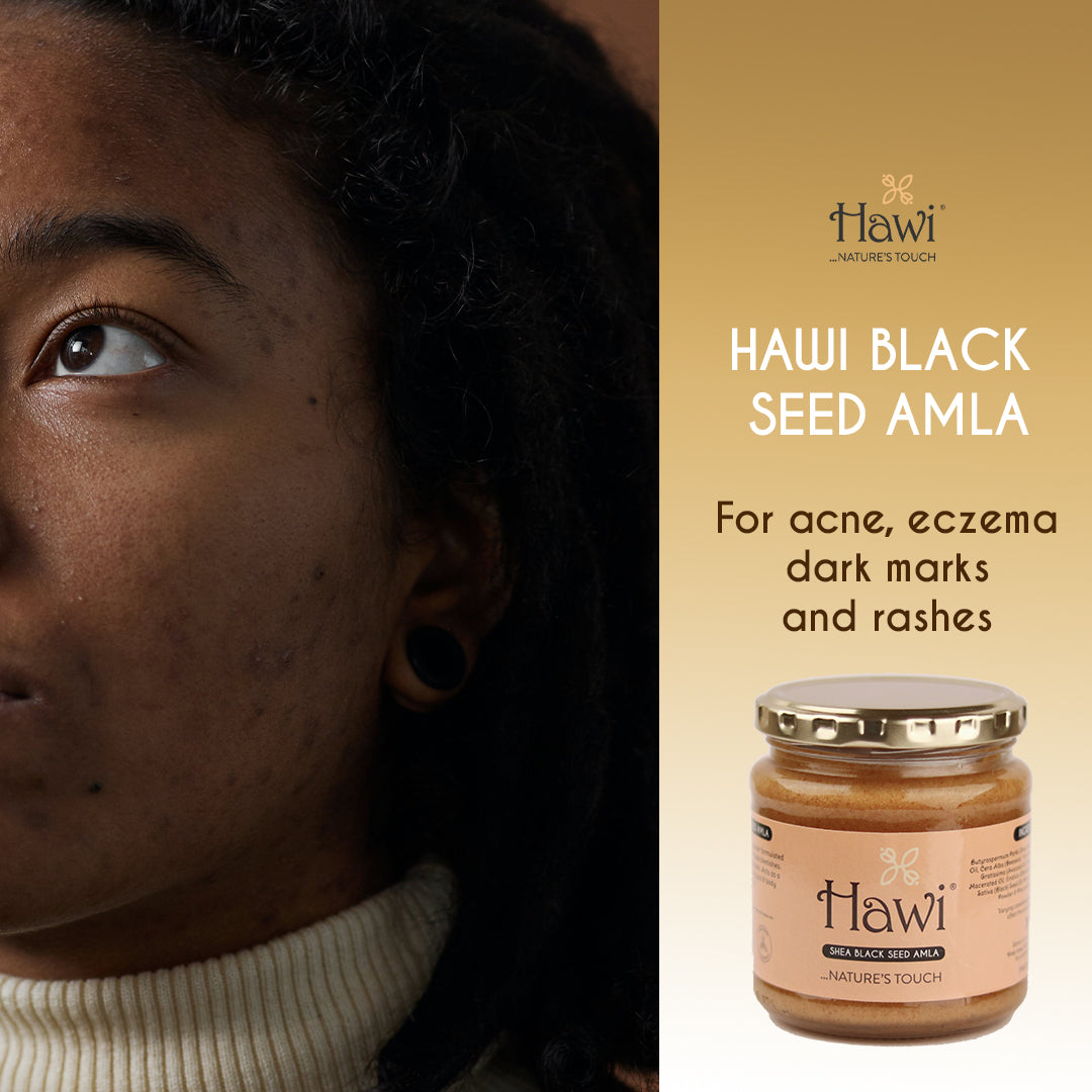Hawi Blackseed Amla Moisturizer - NET WT 291ml (9.8 fl oz) | Acne & Eczema Relief