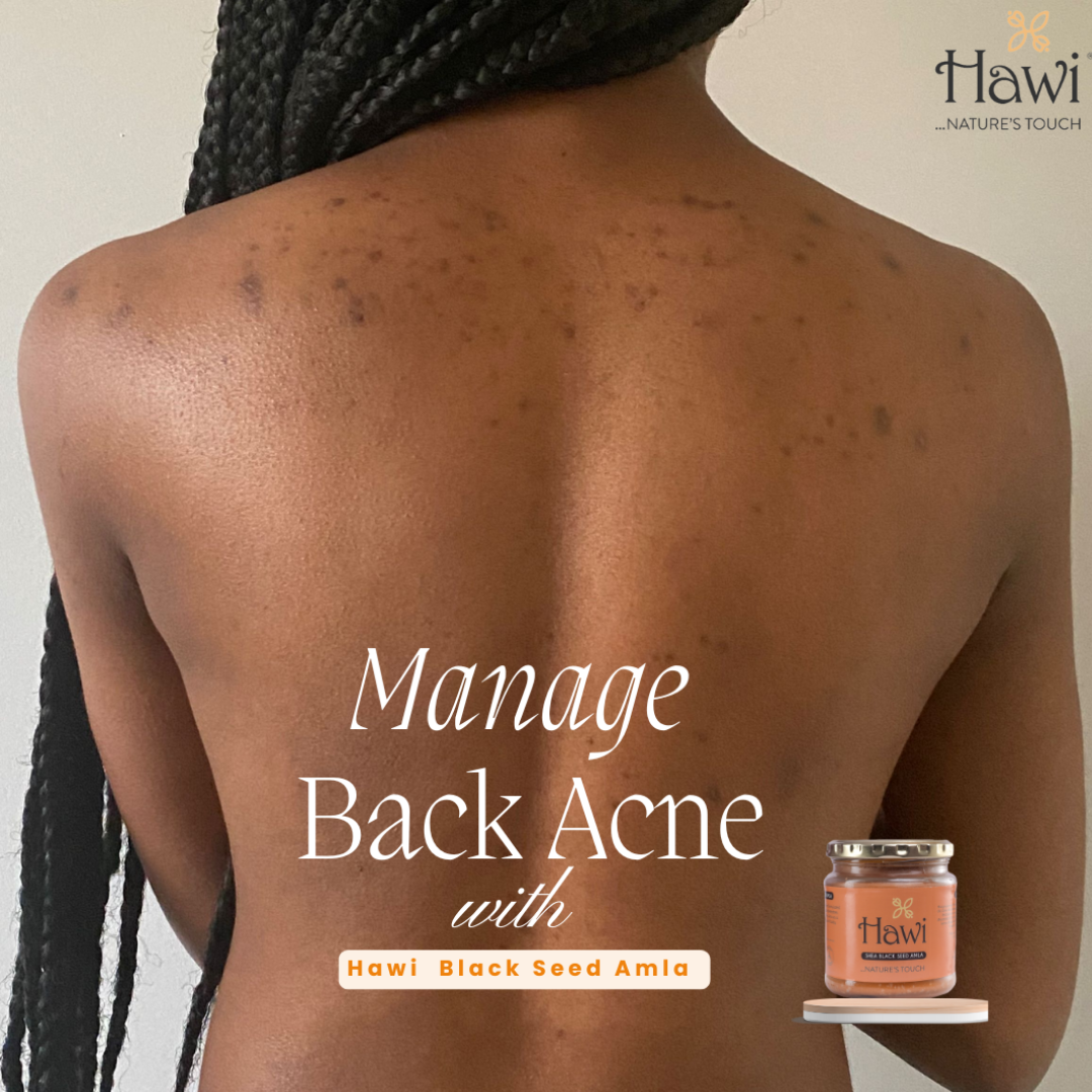 Hawi Blackseed Amla Moisturizer 291ml | Acne & Eczema Relief Cream - Hawi Nature's Touch